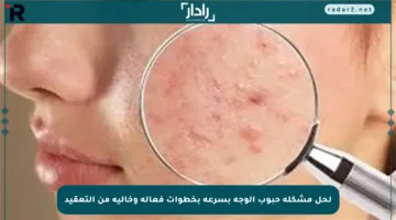 لحل مشكلة حبوب الوجه بسرعة بخطوات فعالة وخالية من التعقيد